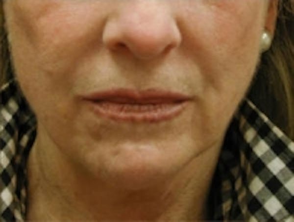Facial Rejuvenation Before & After Gallery - Patient 5930057 - Image 3