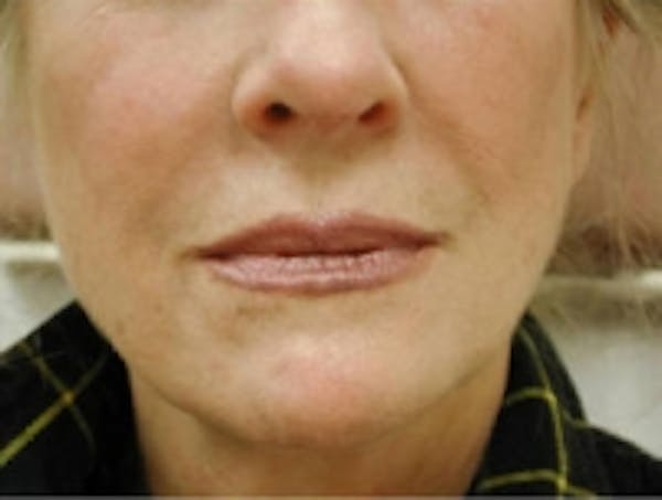 Facial Rejuvenation Before & After Gallery - Patient 5930057 - Image 4