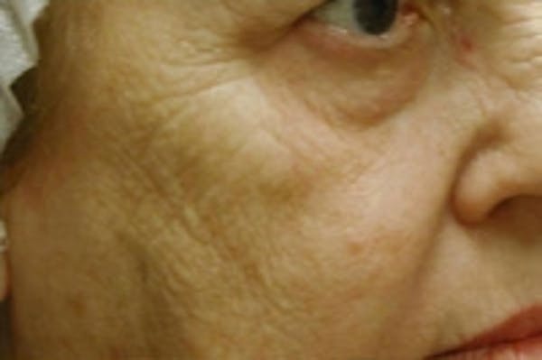 Facial Rejuvenation Before & After Gallery - Patient 5930058 - Image 1