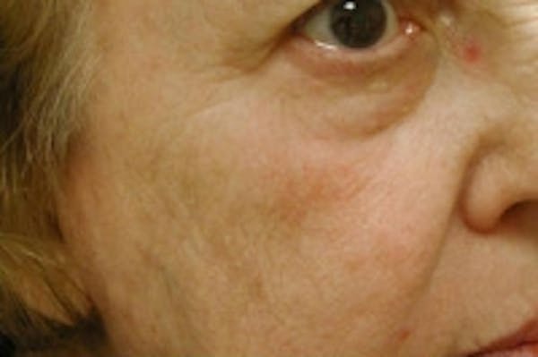 Facial Rejuvenation Gallery - Patient 5930058 - Image 2