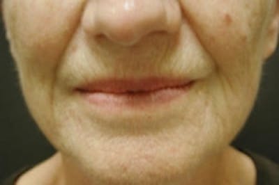 Facial Rejuvenation Before & After Gallery - Patient 5930059 - Image 1