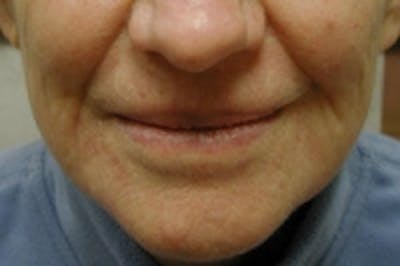 Facial Rejuvenation Before & After Gallery - Patient 5930059 - Image 2