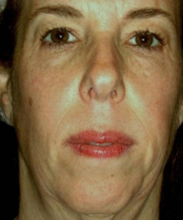 Facial Rejuvenation Gallery - Patient 5930060 - Image 1