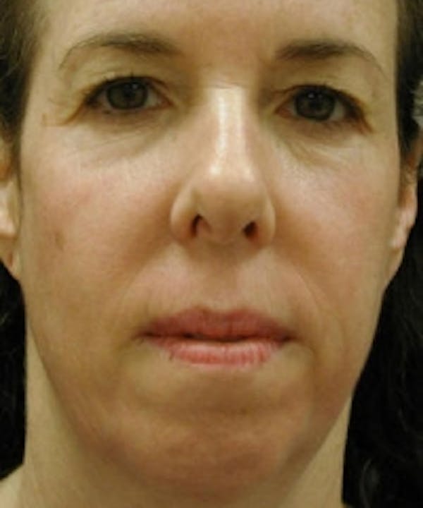 Facial Rejuvenation Before & After Gallery - Patient 5930060 - Image 2