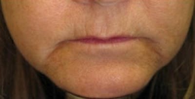 Facial Rejuvenation Before & After Gallery - Patient 5930061 - Image 1