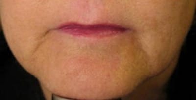 Facial Rejuvenation Before & After Gallery - Patient 5930061 - Image 2