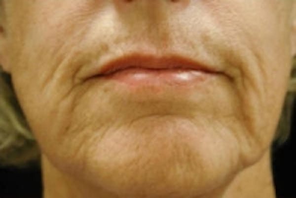 Facial Rejuvenation Before & After Gallery - Patient 5930062 - Image 1