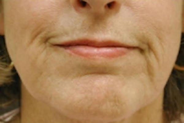 Facial Rejuvenation Before & After Gallery - Patient 5930062 - Image 2