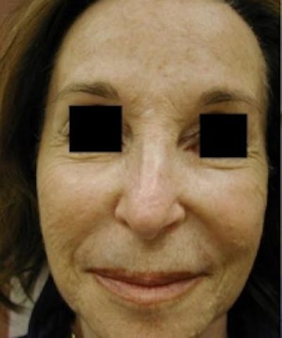 Facial Rejuvenation Before & After Gallery - Patient 5930063 - Image 1
