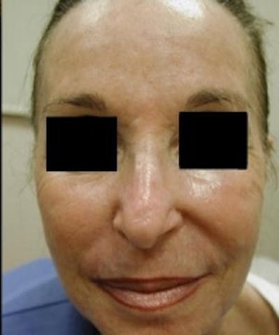 Facial Rejuvenation Before & After Gallery - Patient 5930063 - Image 2