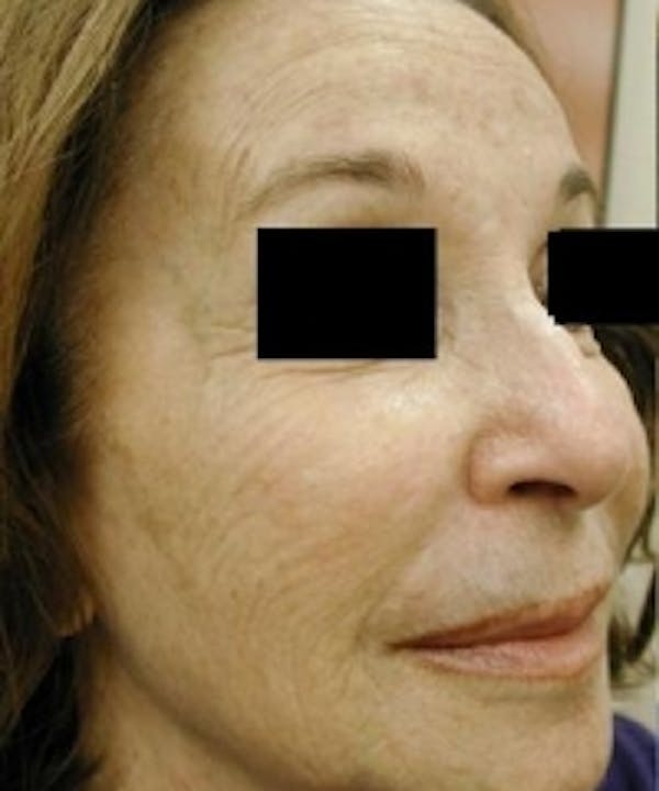Facial Rejuvenation Gallery - Patient 5930064 - Image 1