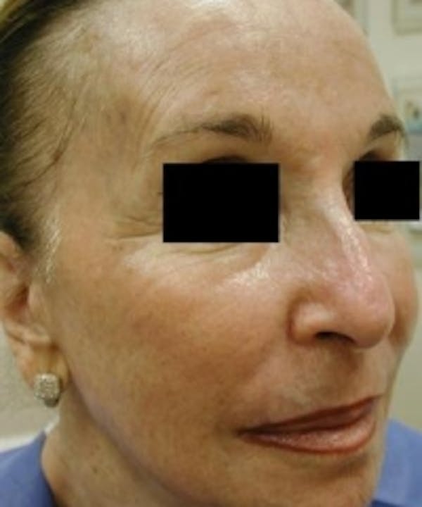 Facial Rejuvenation Before & After Gallery - Patient 5930064 - Image 2