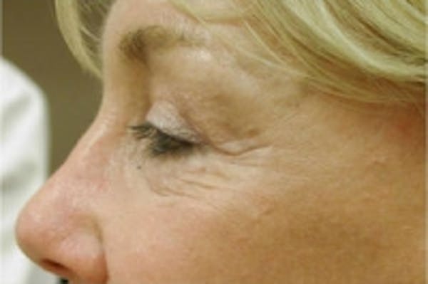 Facial Rejuvenation Before & After Gallery - Patient 5930066 - Image 1