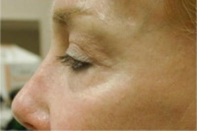 Facial Rejuvenation Before & After Gallery - Patient 5930066 - Image 2