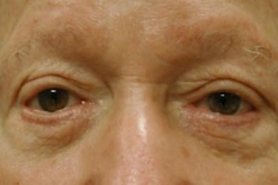 Facial Rejuvenation Before & After Gallery - Patient 5930069 - Image 1