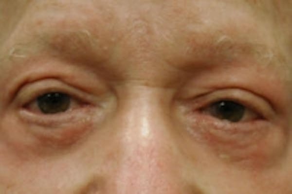 Facial Rejuvenation Before & After Gallery - Patient 5930069 - Image 2