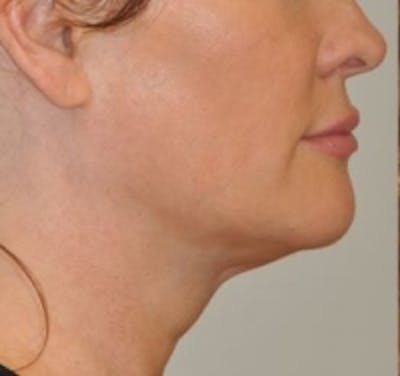 Neck Rejuvenation Before & After Gallery - Patient 5930084 - Image 1