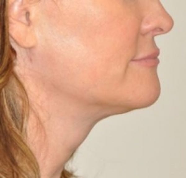 Neck Rejuvenation Before & After Gallery - Patient 5930084 - Image 2