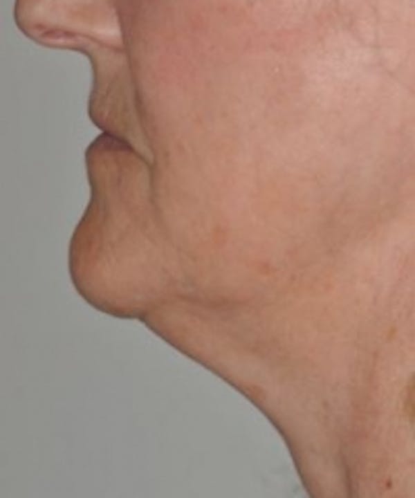 Neck Rejuvenation Before & After Gallery - Patient 5930086 - Image 1