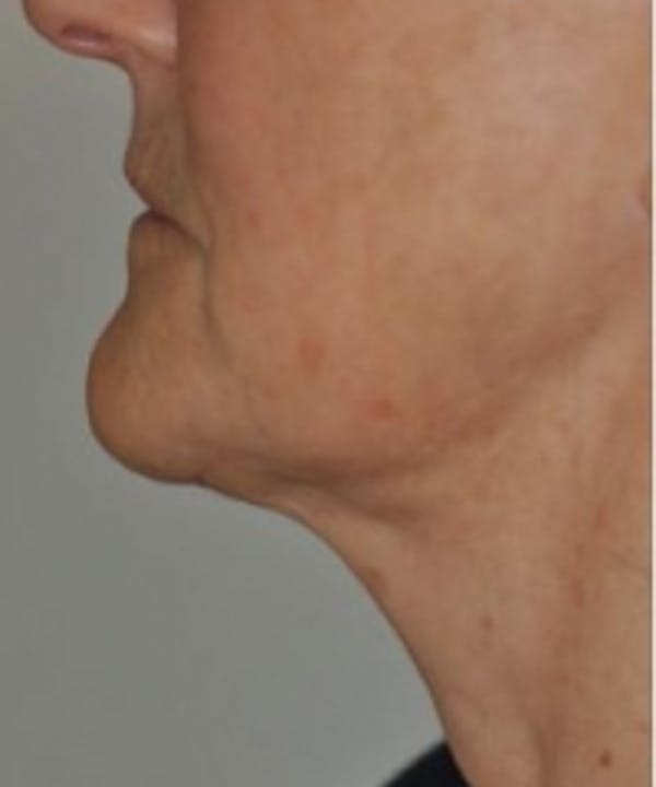 Neck Rejuvenation Before & After Gallery - Patient 5930086 - Image 2