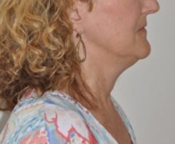 Neck Rejuvenation Before & After Gallery - Patient 5930087 - Image 1