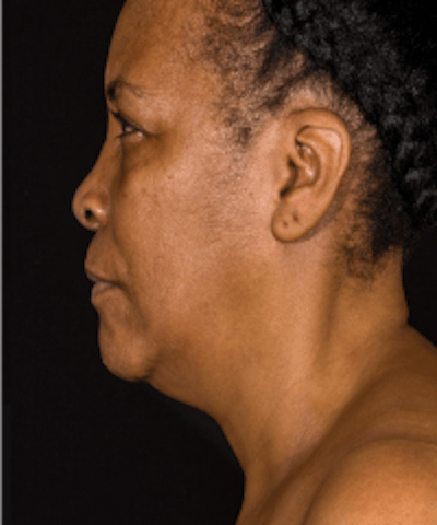 Neck Rejuvenation Before & After Gallery - Patient 5930088 - Image 1