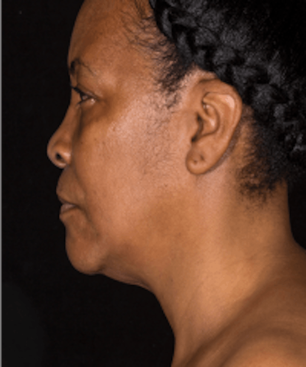 Neck Rejuvenation Before & After Gallery - Patient 5930088 - Image 2