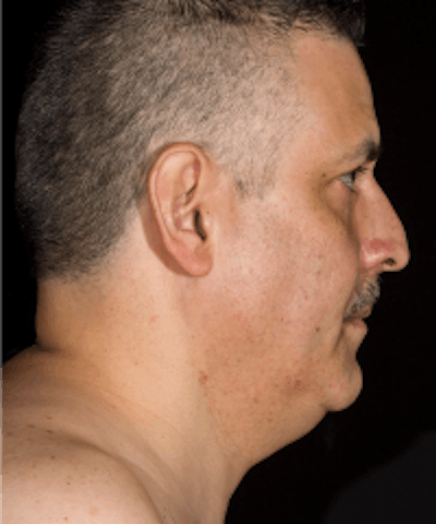 Neck Rejuvenation Before & After Gallery - Patient 5930089 - Image 1