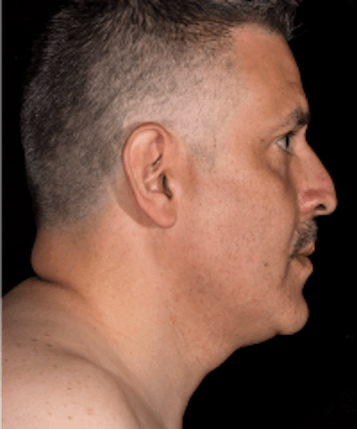 Neck Rejuvenation Before & After Gallery - Patient 5930089 - Image 2