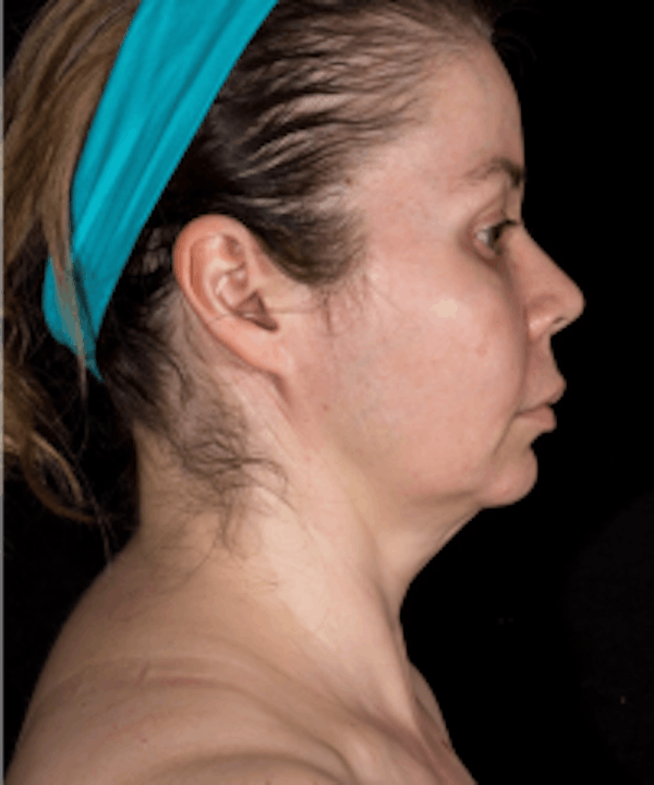 Neck Rejuvenation Before & After Gallery - Patient 5930096 - Image 2