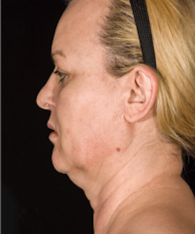 Neck Rejuvenation Before & After Gallery - Patient 5930097 - Image 1