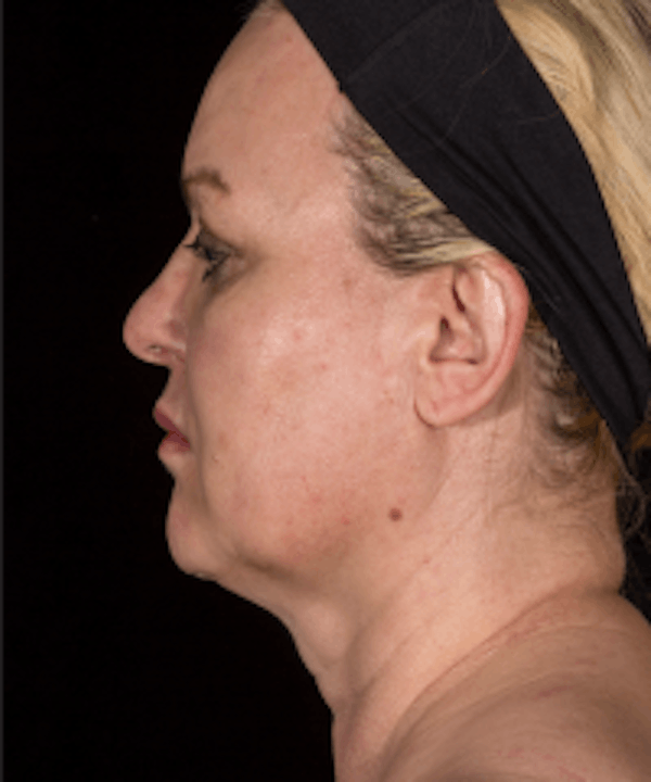 Neck Rejuvenation Before & After Gallery - Patient 5930097 - Image 2