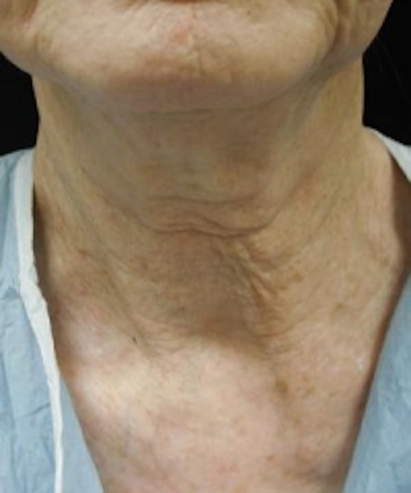 Neck Rejuvenation Before & After Gallery - Patient 5930111 - Image 1