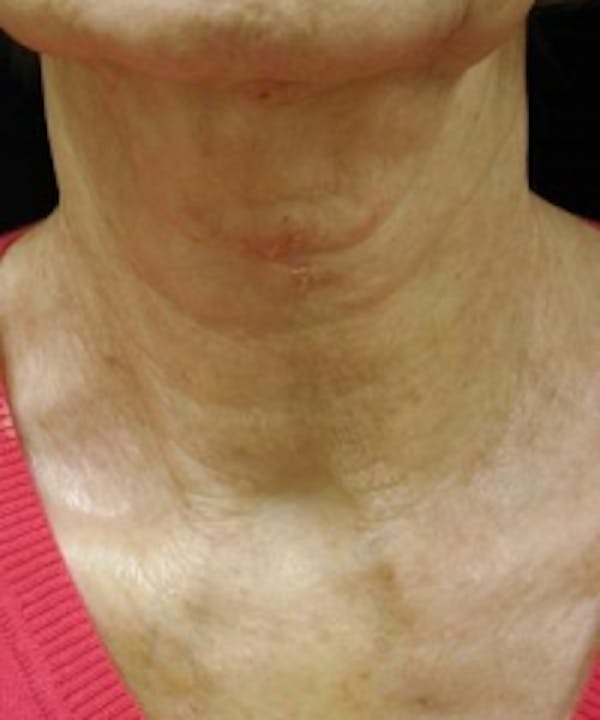 Neck Rejuvenation Before & After Gallery - Patient 5930111 - Image 2