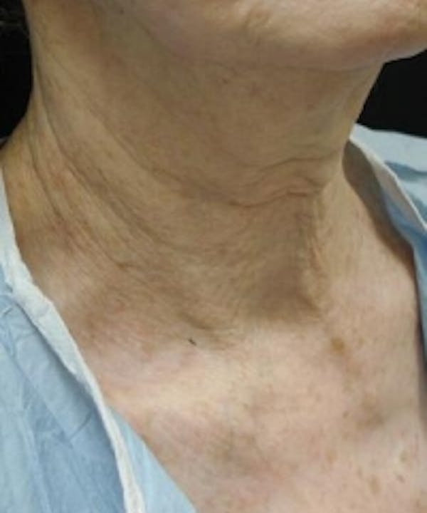 Neck Rejuvenation Before & After Gallery - Patient 5930111 - Image 3