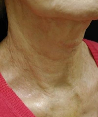 Neck Rejuvenation Before & After Gallery - Patient 5930111 - Image 4