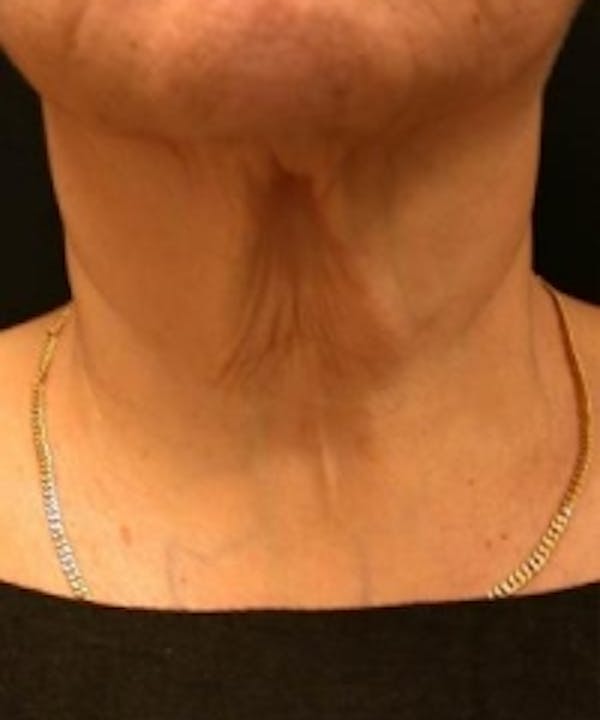 Neck Rejuvenation Before & After Gallery - Patient 5930113 - Image 1