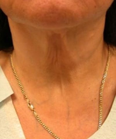 Neck Rejuvenation Before & After Gallery - Patient 5930113 - Image 2