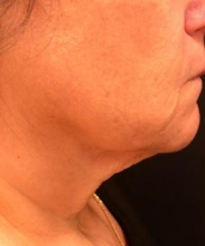 Neck Rejuvenation Before & After Gallery - Patient 5930114 - Image 1