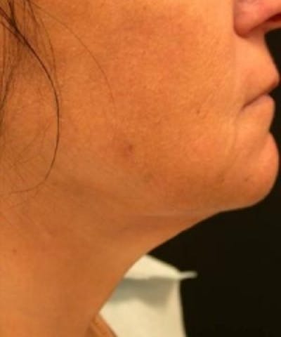 Neck Rejuvenation Before & After Gallery - Patient 5930114 - Image 2