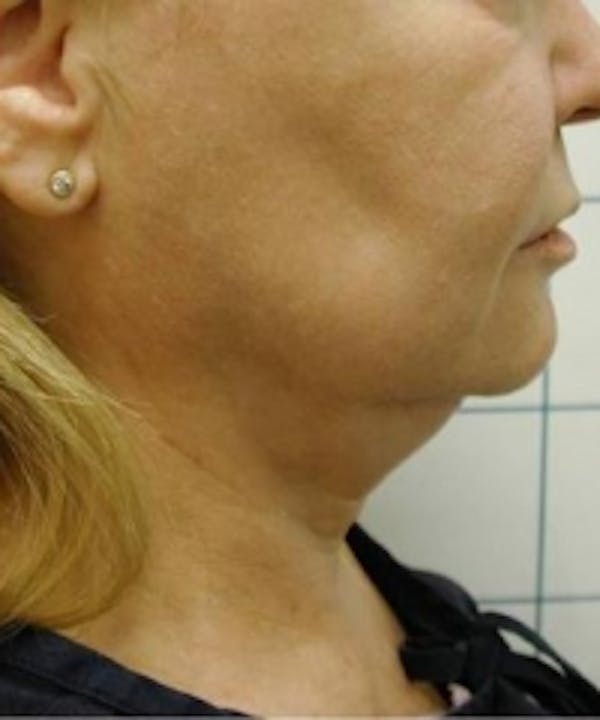 Neck Rejuvenation Before & After Gallery - Patient 5930115 - Image 1