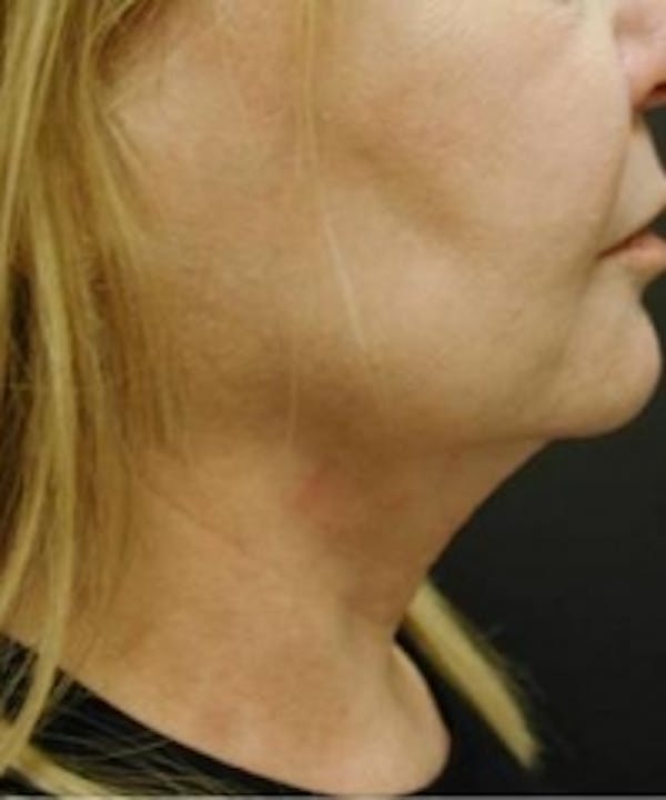 Neck Rejuvenation Before & After Gallery - Patient 5930115 - Image 2