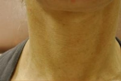 Neck Rejuvenation Before & After Gallery - Patient 5930116 - Image 1