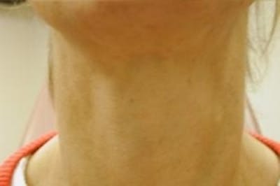 Neck Rejuvenation Before & After Gallery - Patient 5930116 - Image 2