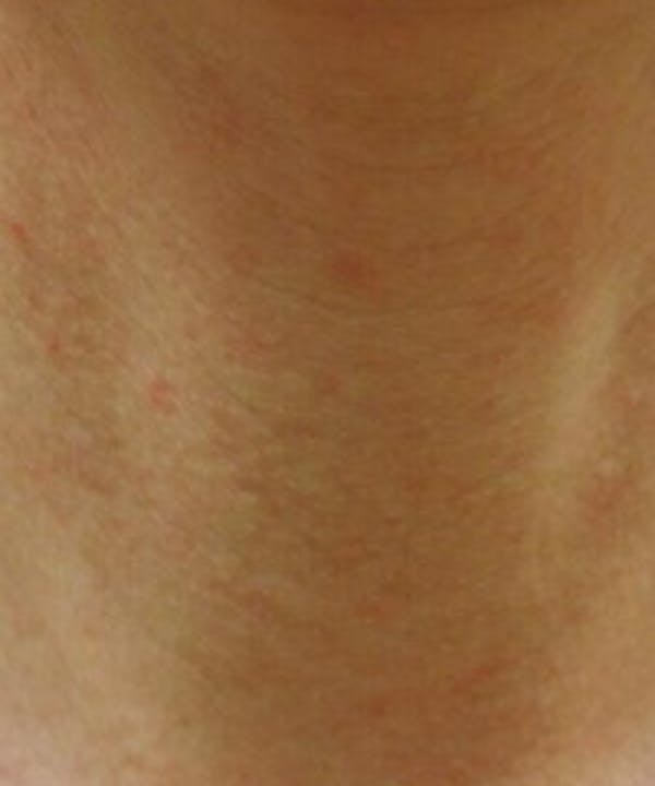 Neck Rejuvenation Before & After Gallery - Patient 5930117 - Image 1