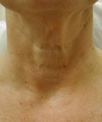 Neck Rejuvenation Before & After Gallery - Patient 5930118 - Image 1