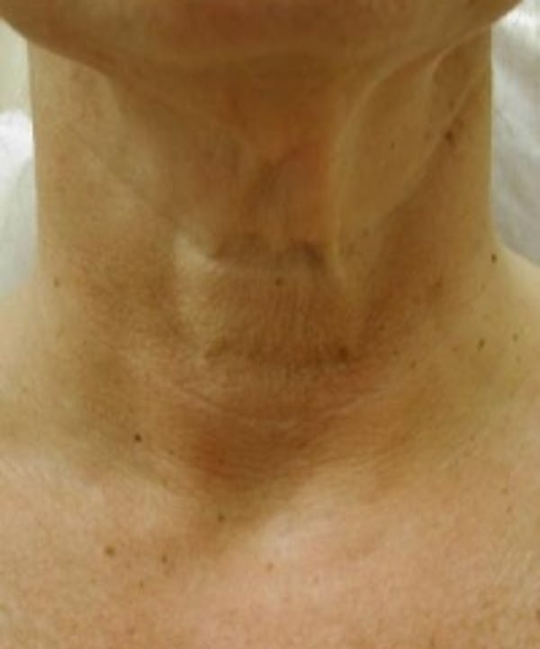 Neck Rejuvenation Before & After Gallery - Patient 5930118 - Image 1