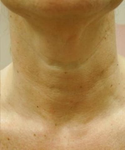 Neck Rejuvenation Before & After Gallery - Patient 5930118 - Image 2