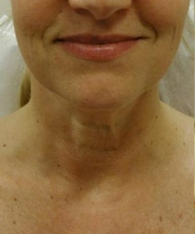 Neck Rejuvenation Before & After Gallery - Patient 5930119 - Image 1