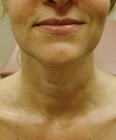 Neck Rejuvenation Before & After Gallery - Patient 5930119 - Image 2